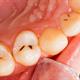 علائم کرم خوردگی دندان چیست و چگونه از آن جلوگیری کنیم؟
